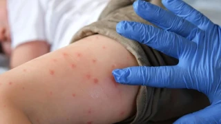 Морбили у нас: Какви са симптомите и възможните усложнения?